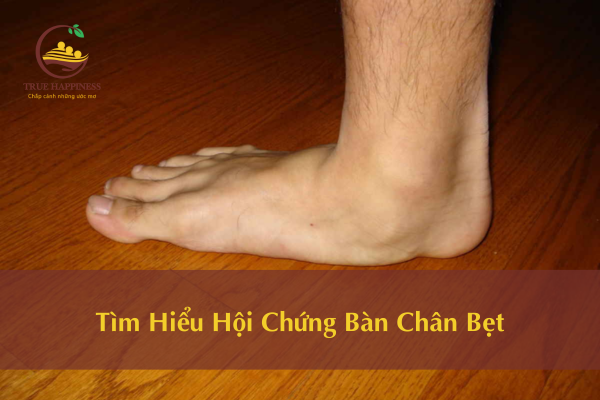 Tìm Hiểu Hội Chứng Bàn Chân Bẹt