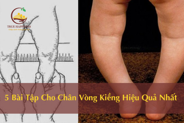 5 Bài Tập Cho Chân Vòng Kiềng Hiệu Quả Nhất